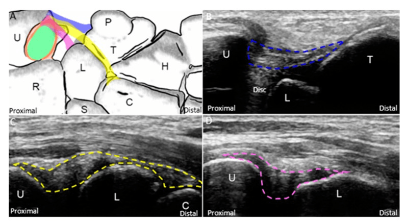 Schematic (A) and ultrasound views (B to D) of the ulnotriquetral, ulnocapitate and ulnolunate ligaments, each outlined by a coloured dashed line