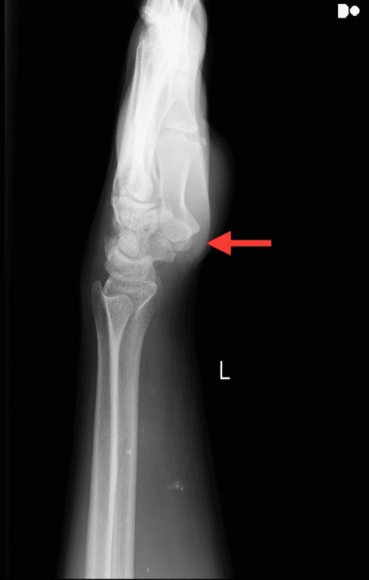 Lateral wrist radiograph, marked L, with a red arrow at the carpus, showing volar intercalated segment instability alignment