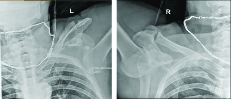Bilateral shoulder radiographs demonstrating simultaneous bilateral luxatio erecta