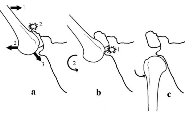 Diagram of the hyperabduction mechanism of true inferior shoulder dislocation showing the humerus levering over the acromion