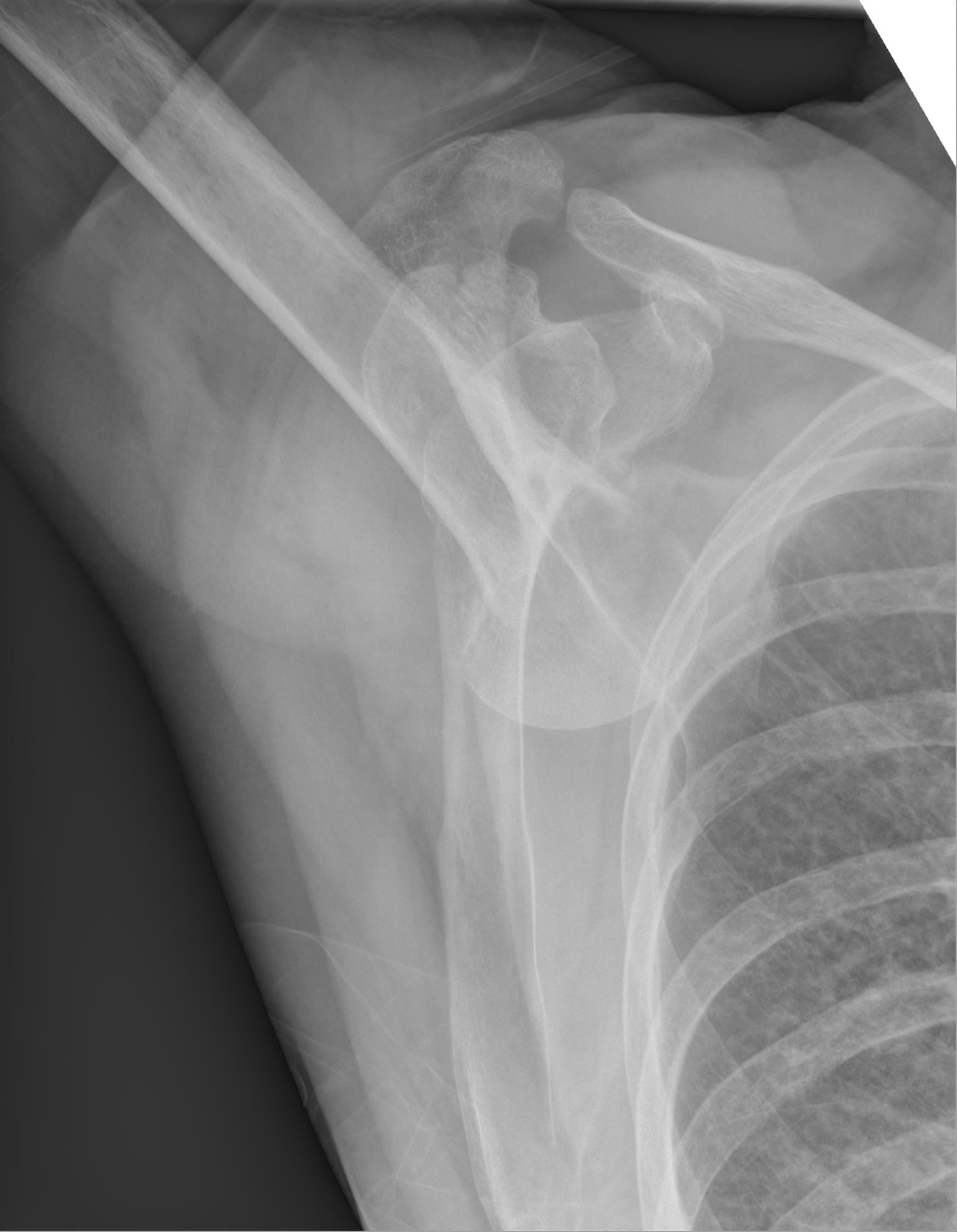 AP shoulder radiograph of luxatio erecta showing the humerus abducted with the head displaced inferiorly below the glenoid