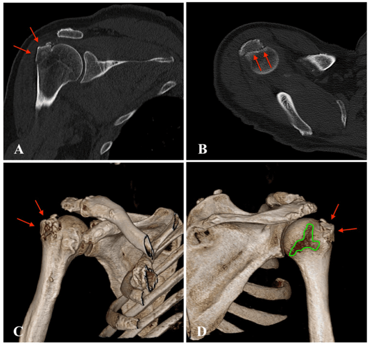 CT of the shoulder after inferior dislocation showing greater tuberosity fracture on coronal, axial and 3D reconstructions