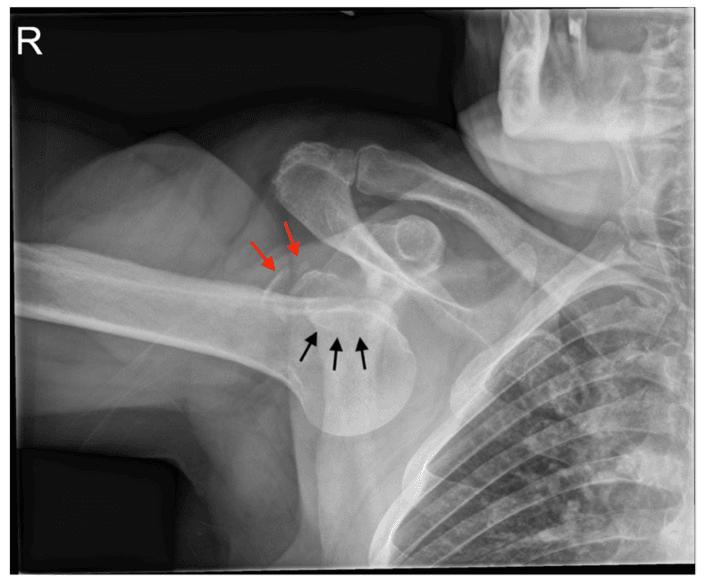 Radiograph of inferior shoulder dislocation with the arm fixed in abduction and a greater tuberosity fracture