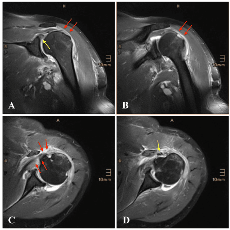 MRI of the shoulder after inferior dislocation showing a supraspinatus tendon tear and SLAP lesion