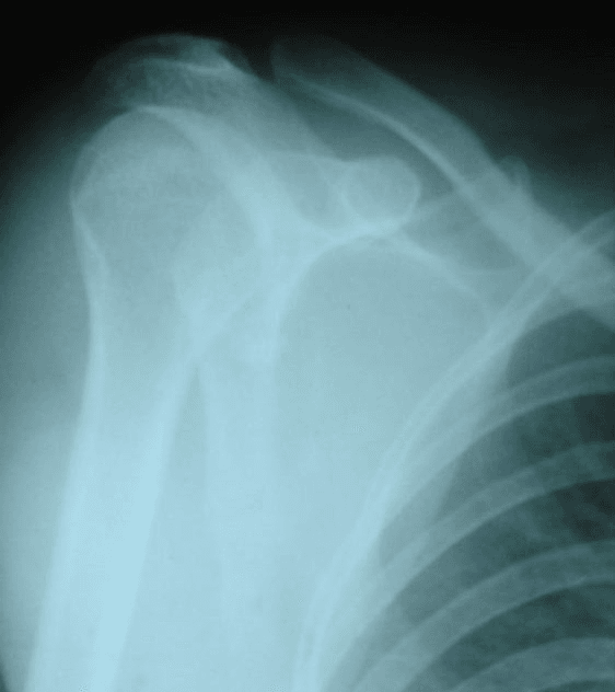 Post-reduction radiograph showing concentric reduction of the glenohumeral joint