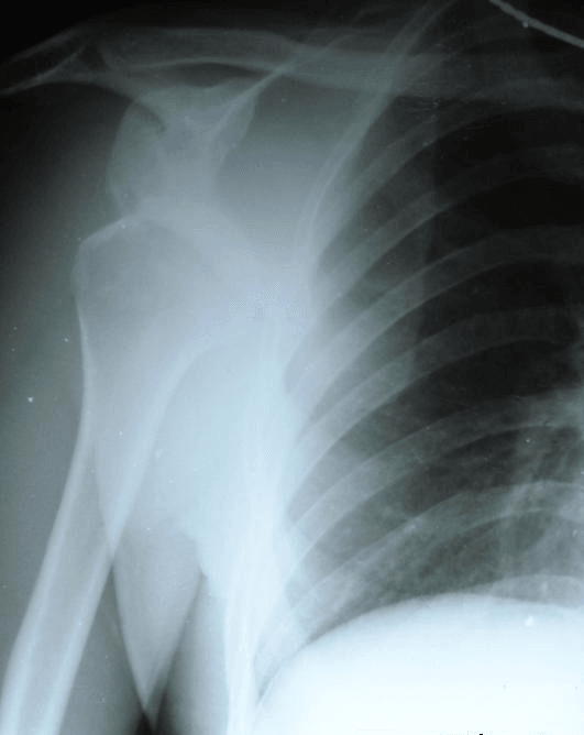 Pre-reduction radiograph of subglenoid inferior dislocation with the humerus lying parallel to the chest wall