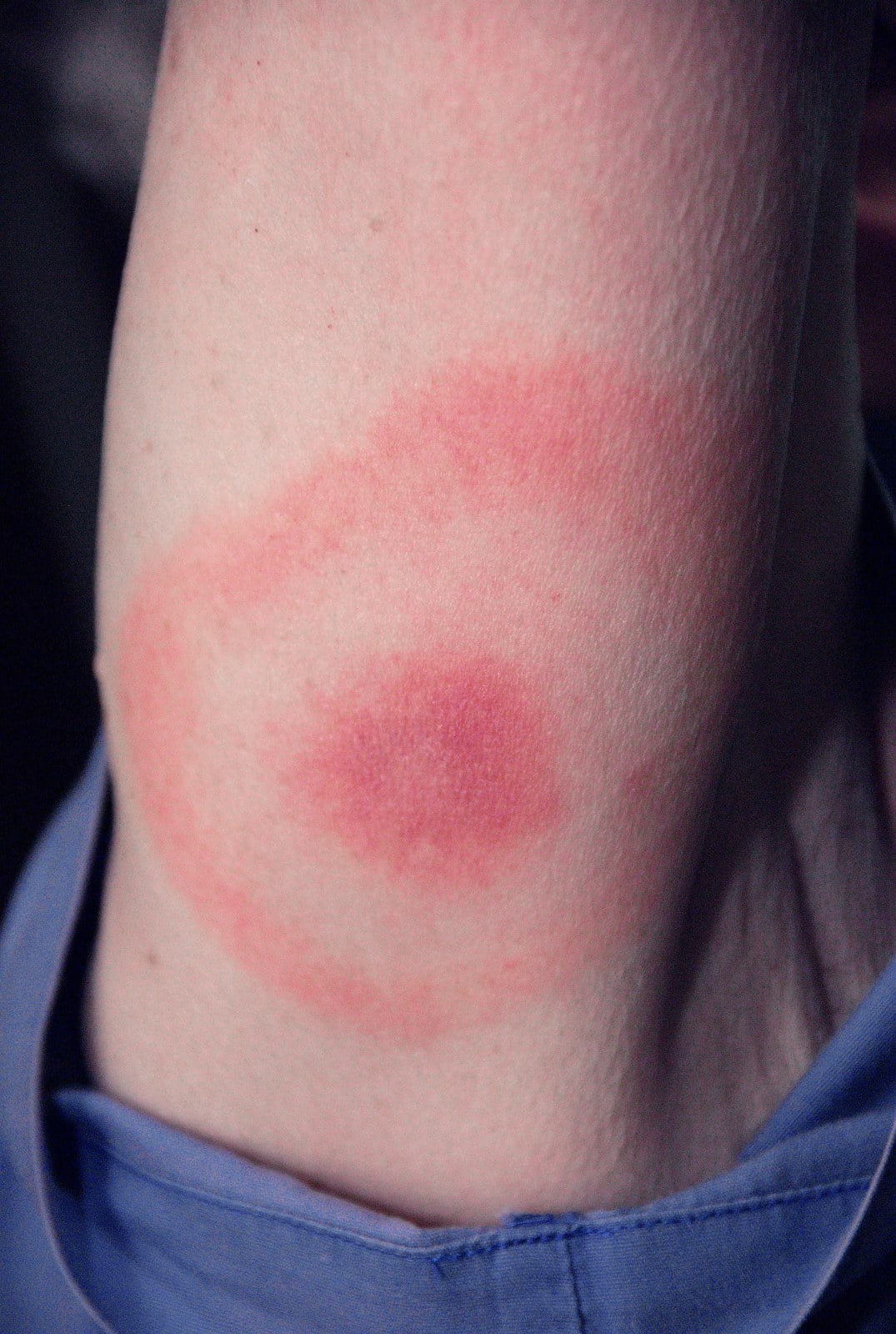 Erythema migrans bull's-eye rash at a tick-bite site on the posterior upper arm