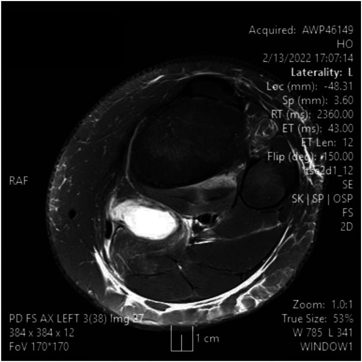 Axial proton-density fat-saturated MRI of a left knee in Lyme arthritis showing a large fluid-bright popliteal Baker cyst behind the joint.