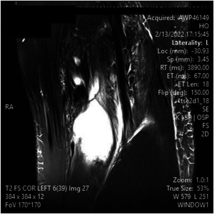 Coronal T2 fat-saturated MRI of the same left knee showing the craniocaudal extent of a large fluid-bright popliteal Baker cyst in Lyme arthritis.