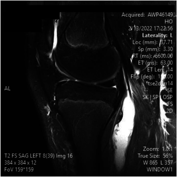 Sagittal T2 fat-saturated MRI of the same left knee showing a distended fluid-filled popliteal bursa behind the knee in Lyme arthritis.
