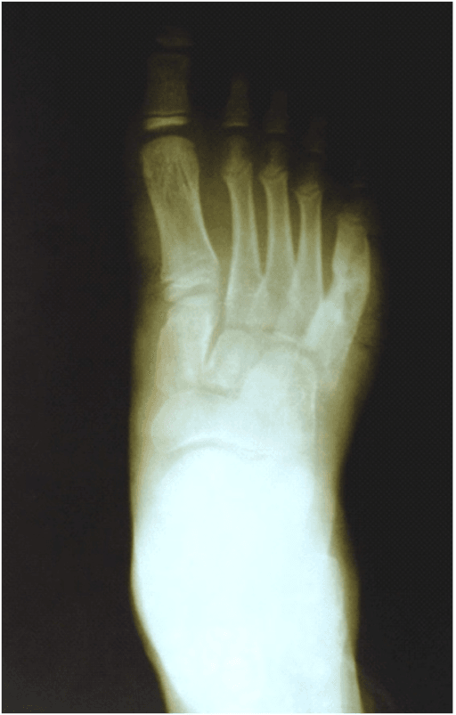 Foot radiograph with an eccentric lucent lesion in the shaft of the fifth metatarsal, bordered by a rim of sclerosis.