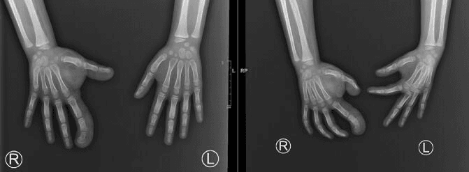 Bilateral hand radiographs in two projections showing enlargement of the thumb and index ray of the hand marked R