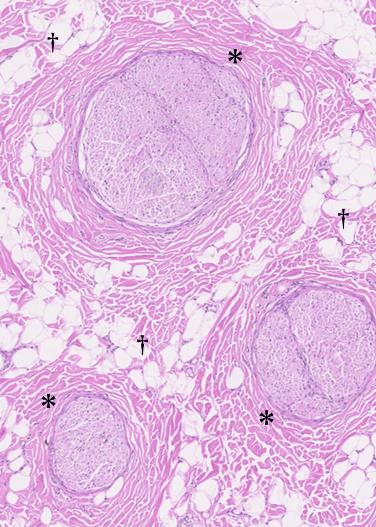 Histology showing fibroadipose expansion around digital nerve bundles