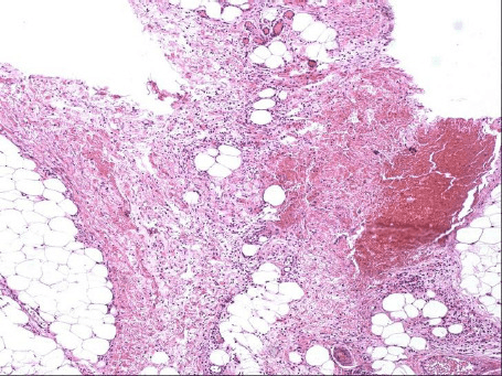 Histological section of fibrolipomatous hamartoma of nerve showing mature fat cells within fibrous tissue