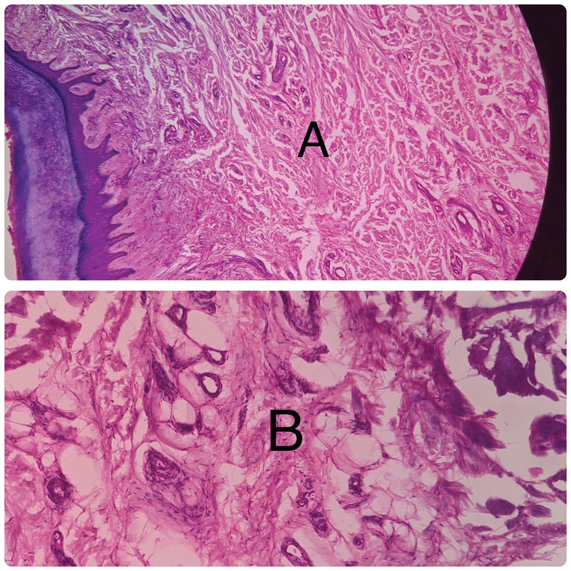 Two histology panels from foot macrodactyly: dense fibrous tissue beneath the skin, and fat cells within fibrous strands