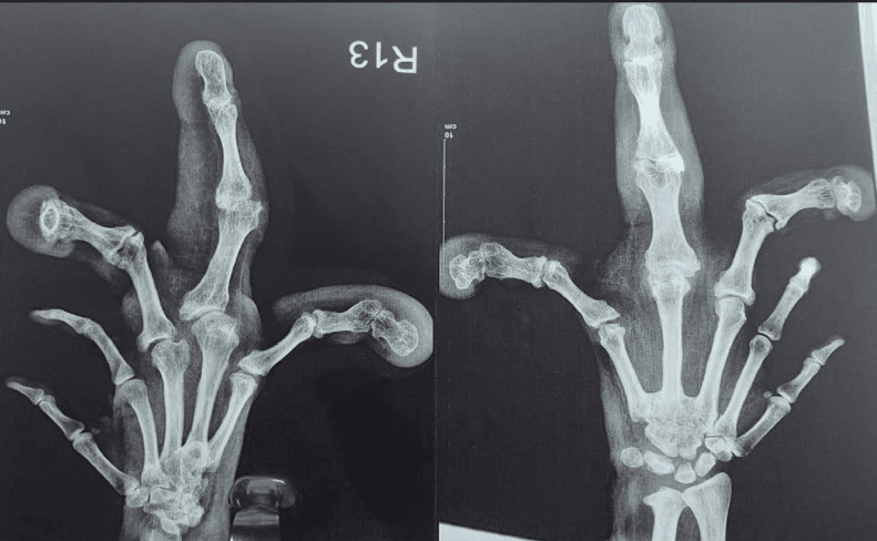 Two radiographs of a hand with macrodactyly showing one grossly enlarged digit and curved adjacent digits
