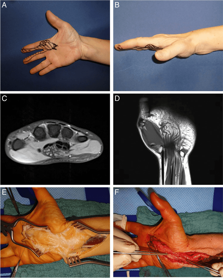 Clinical photographs, MRI and operative images of lipomatosis of the median nerve, panels A-F