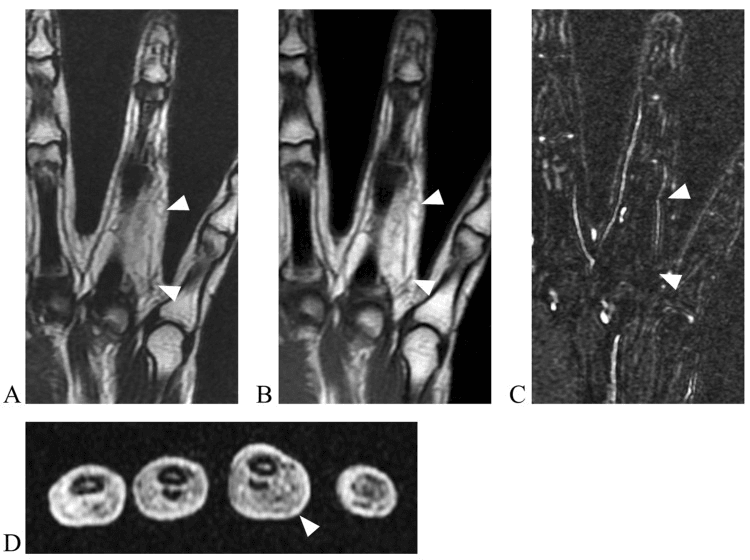 Four-panel MRI (A-D) of a fatty lesion along a finger, marked by arrowheads