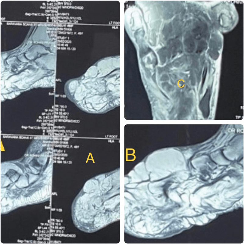 MRI panels A-C of the left foot in lipofibromatous hamartoma of the superficial peroneal nerve with macrodactyly
