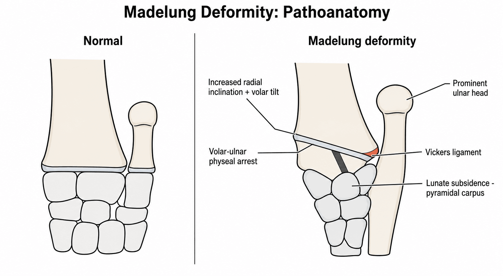 Two-panel diagram comparing a normal wrist with the pathoanatomy of Madelung deformity: arrested volar-ulnar physis, Vickers ligament tethering the lunate, increased radial inclination and volar tilt, lunate subsidence and a prominent ulnar head.