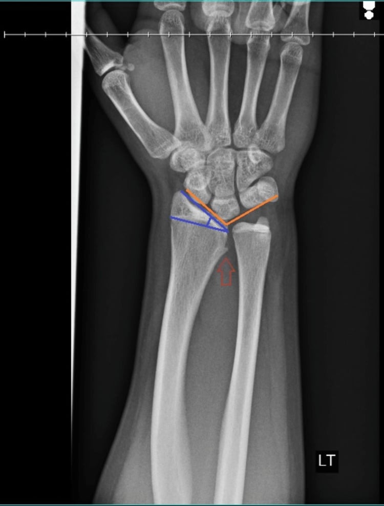 Annotated AP wrist radiograph showing increased radial inclination, abnormal carpal angle and a medial distal radial spur in Madelung deformity