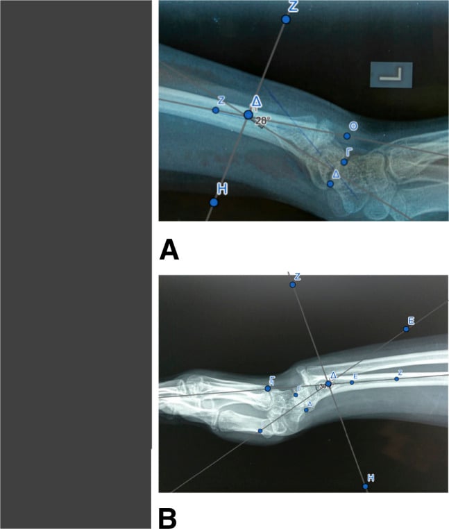 Intraoperative radiographs showing distal radial osteotomies performed for bilateral Madelung deformity correction