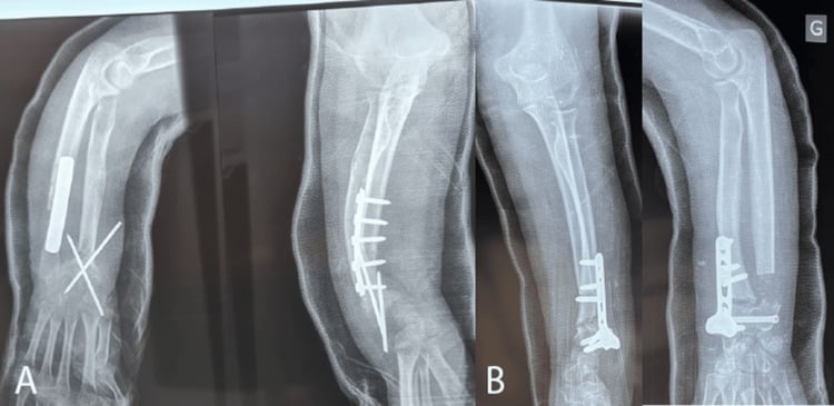 Postoperative AP and lateral radiographs of both forearms after bilateral correction of Madelung deformity