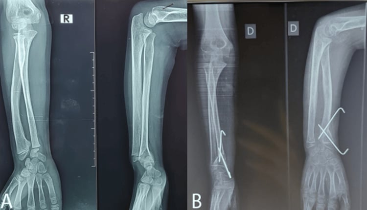 Preoperative and postoperative AP and lateral wrist radiographs in a sibling with Leri-Weill syndrome and Madelung deformity