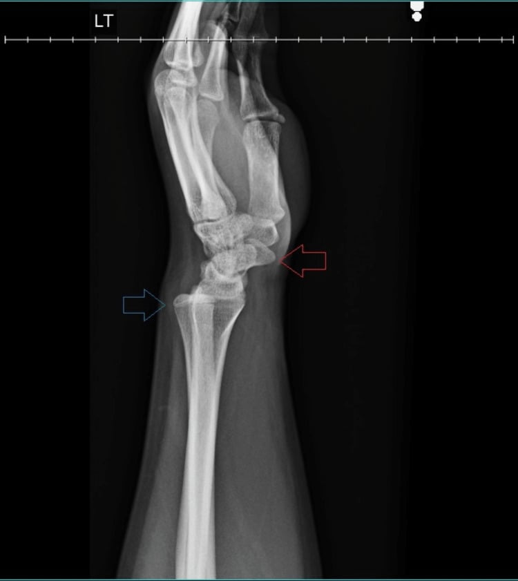 Lateral wrist radiograph showing dorsal subluxation of the distal ulna and volar subluxation of the hand in Madelung deformity