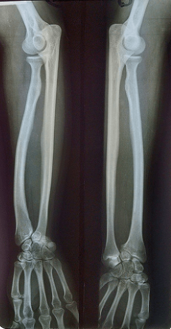 Comparative posteroanterior radiographs of both forearms and wrists showing bilateral distal radius deformity and radial bowing