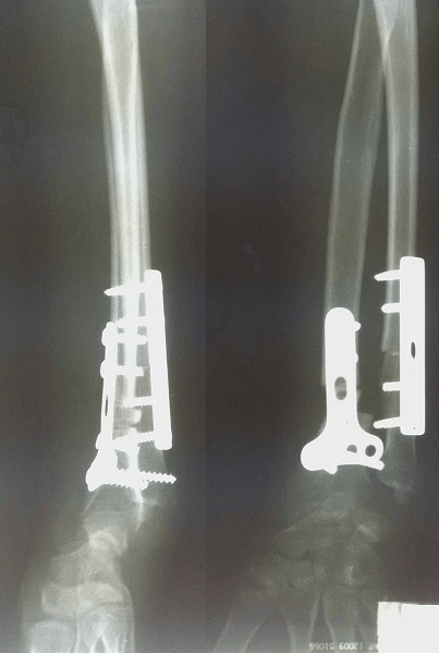 Postoperative radiographs of a distal radius corrective osteotomy held with a volar locking plate and screws, in two views