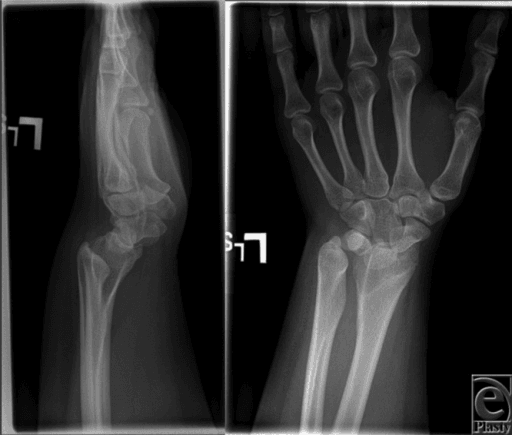 Two-panel radiograph of one wrist: a lateral view showing the carpus displaced towards the palm and a posteroanterior view showing increased radial inclination
