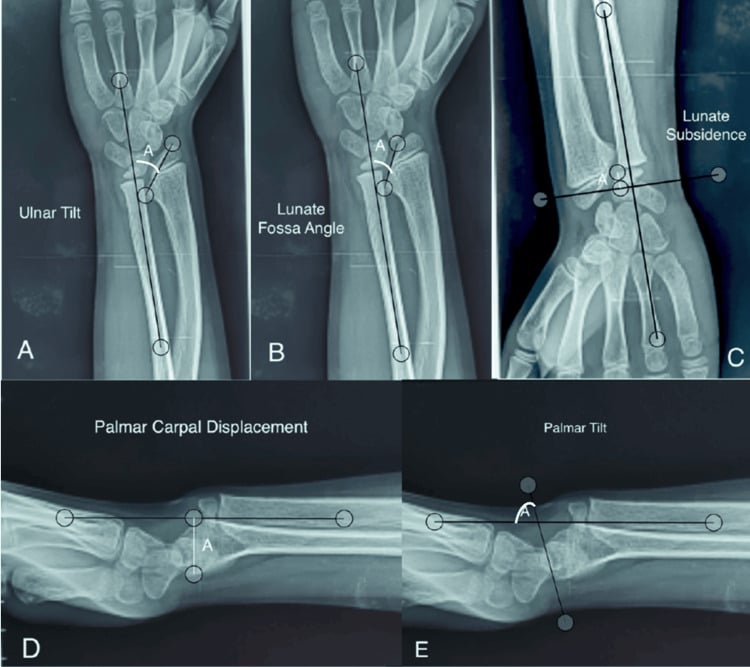 Five annotated wrist radiographs demonstrating McCarroll measurements of ulnar tilt, lunate fossa angle, lunate subsidence, palmar carpal displacement and palmar tilt