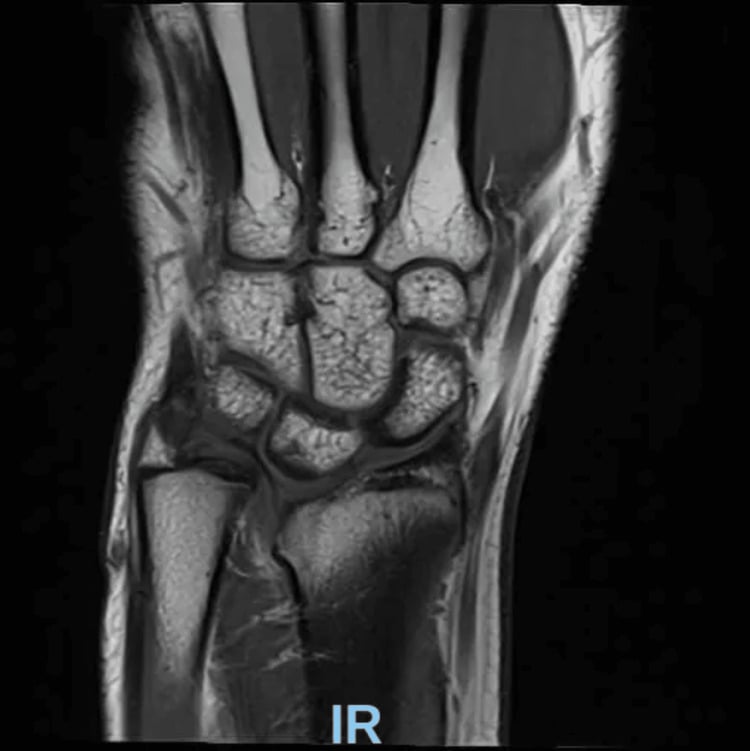 Coronal wrist MRI showing preservation of the radial physis but absence of the volar-ulnar portion from premature closure