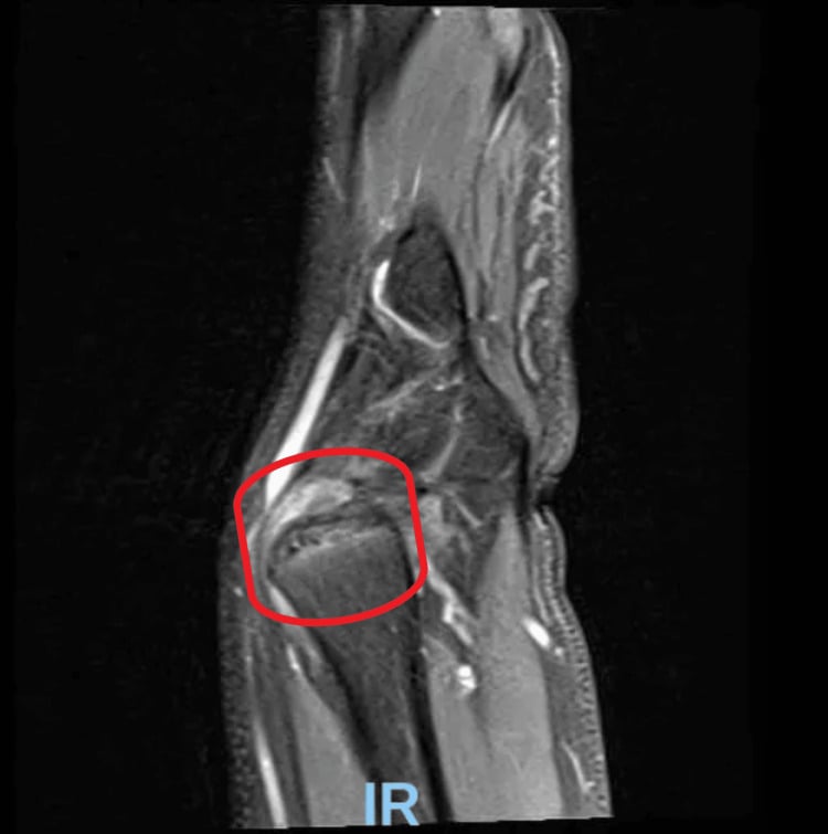Sagittal fluid-sensitive wrist MRI showing positive ulnar variance with marrow oedema in the ulnar head