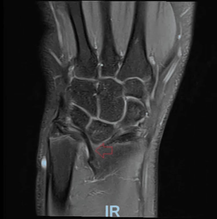 Coronal wrist MRI with an arrow identifying the abnormal Vickers ligament arising from the distal radial metaphysis