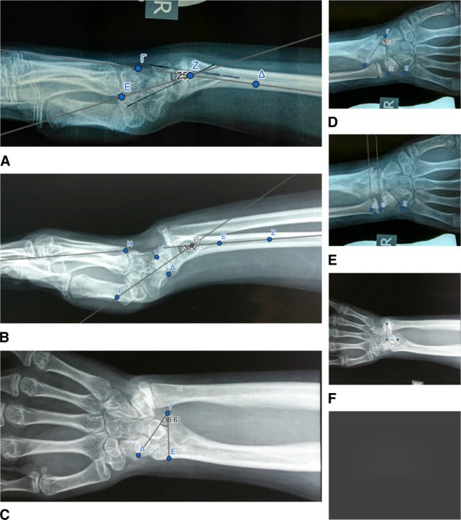 Serial AP and lateral wrist radiographs over one year showing progression of Madelung deformity with increasing volar tilt and carpal malalignment