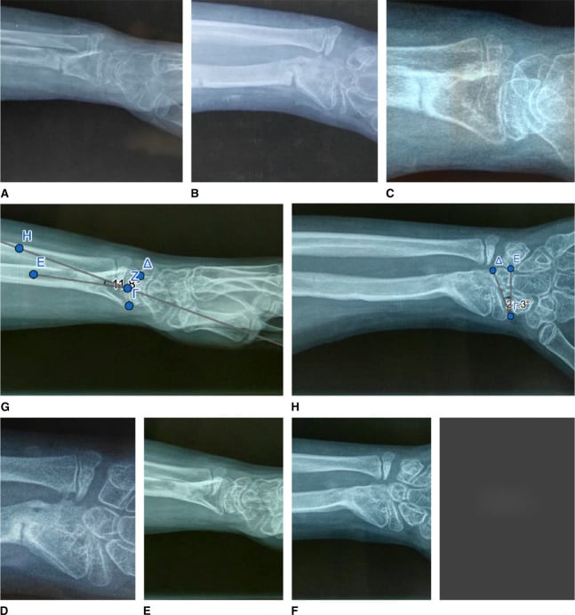AP and lateral wrist radiographs after gradual correction showing restored radiocarpal alignment