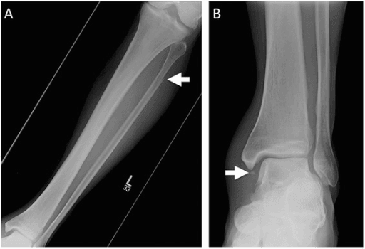 Maisonneuve fracture radiographs showing proximal fibula fracture and ankle syndesmotic injury
