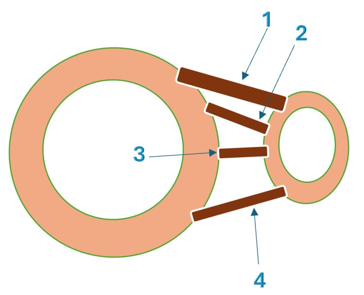 Axial diagram of the four ligament components of the distal tibiofibular syndesmosis