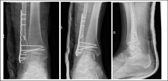 AP mortise and lateral radiographs after fixation of a double Maisonneuve injury