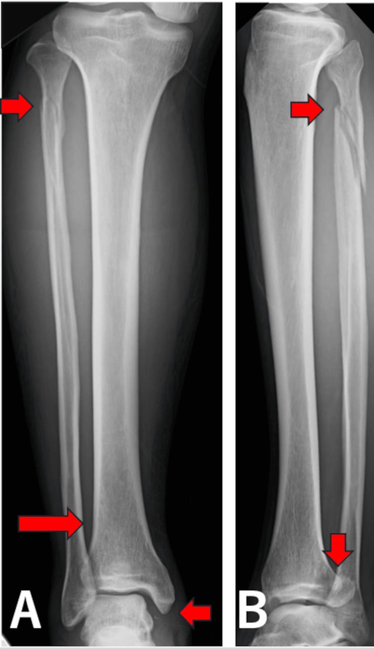 Full-length AP and lateral radiographs showing proximal fibular fracture and unstable ankle injury