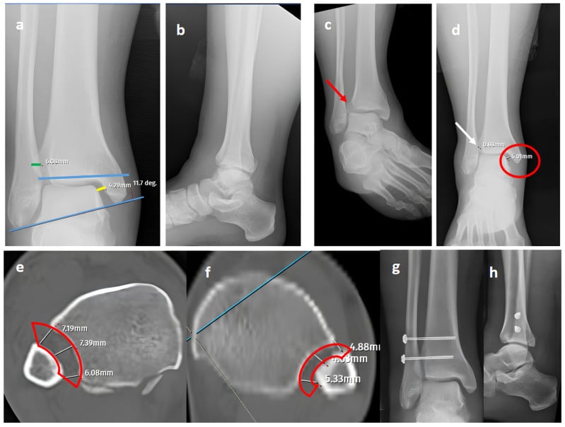 Radiographic and CT montage of a pronation external rotation stage IV Maisonneuve fracture