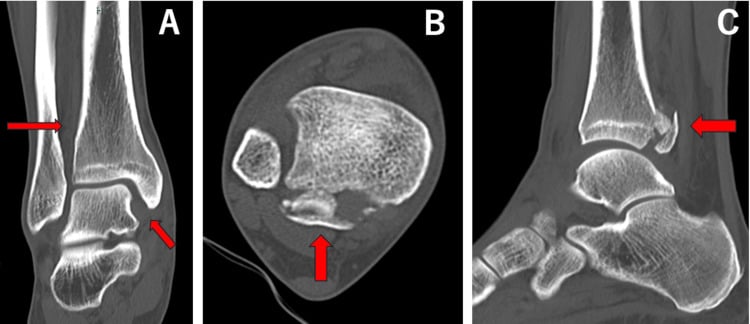 Coronal axial and sagittal CT of Maisonneuve injury with posterior malleolar fracture