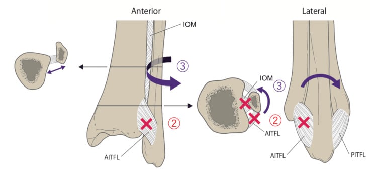 Diagram of pronation external rotation progression through the syndesmosis and interosseous membrane
