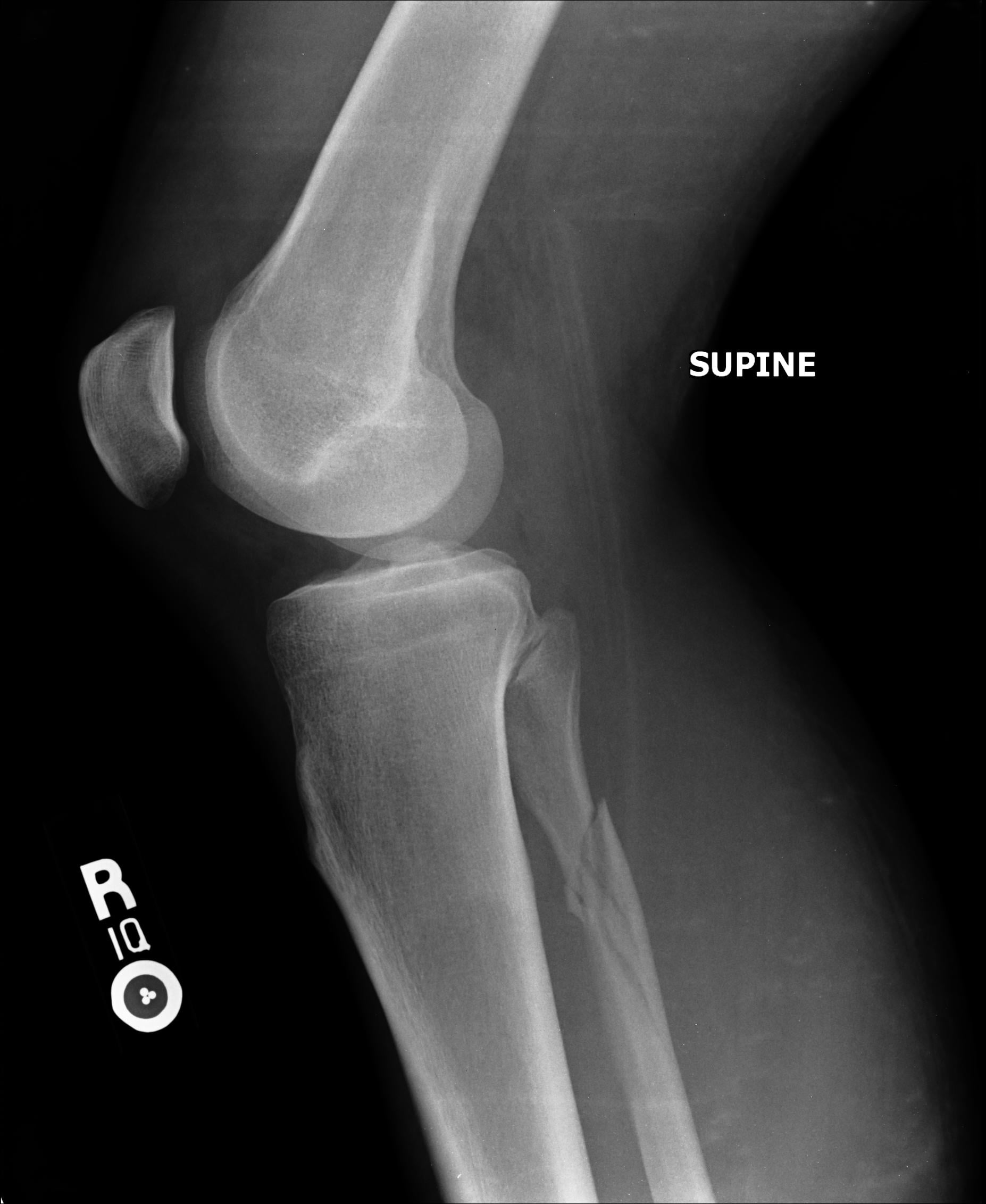 Radiograph of the proximal fibula fracture of a Maisonneuve injury.