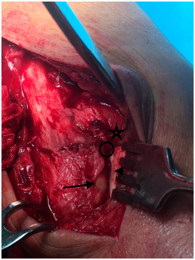 Direct operative view of the anterior incisura corner during open syndesmosis reduction