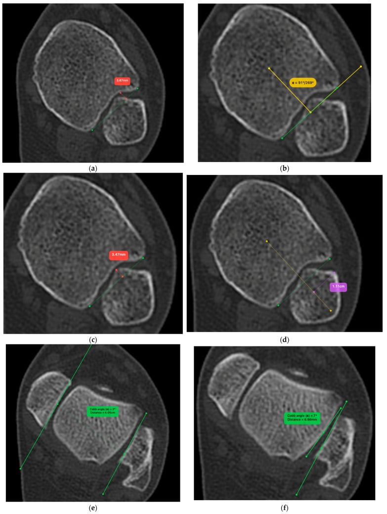 Axial CT measurements of incisura depth rotation engagement and fibular translation