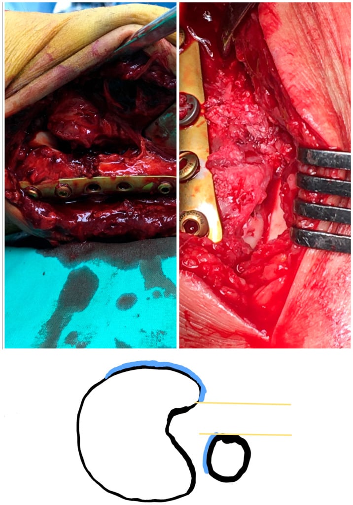 Operative comparison of posteriorly translated and anatomically reduced distal fibula