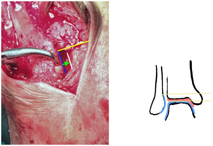 Operative landmarks used to restore distal fibular length before syndesmosis fixation
